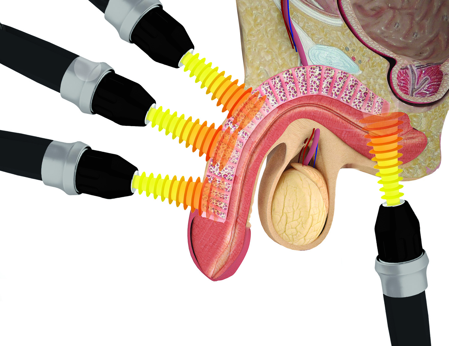 How P-Wave shockwave therapy works — before and after illustration showing new blood vessel formation