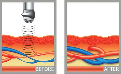 How V-Wave acoustic wave therapy works — before and after illustration showing new blood vessel formation