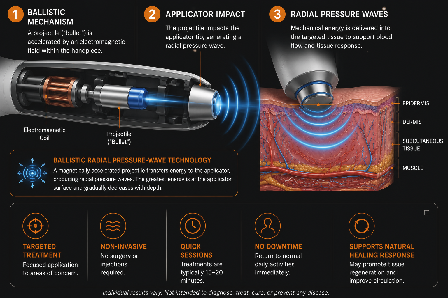 Infographic showing how V-Wave acoustic wave therapy works: ballistic mechanism, applicator impact, and radial pressure waves delivered into targeted tissue, with benefits including targeted treatment, non-invasive application, quick sessions, no downtime, and support for natural healing response